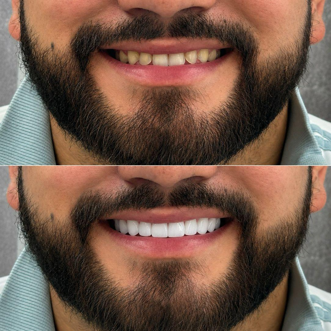Antes y después de un caso real de diseño de sonrisa en Soi Smile