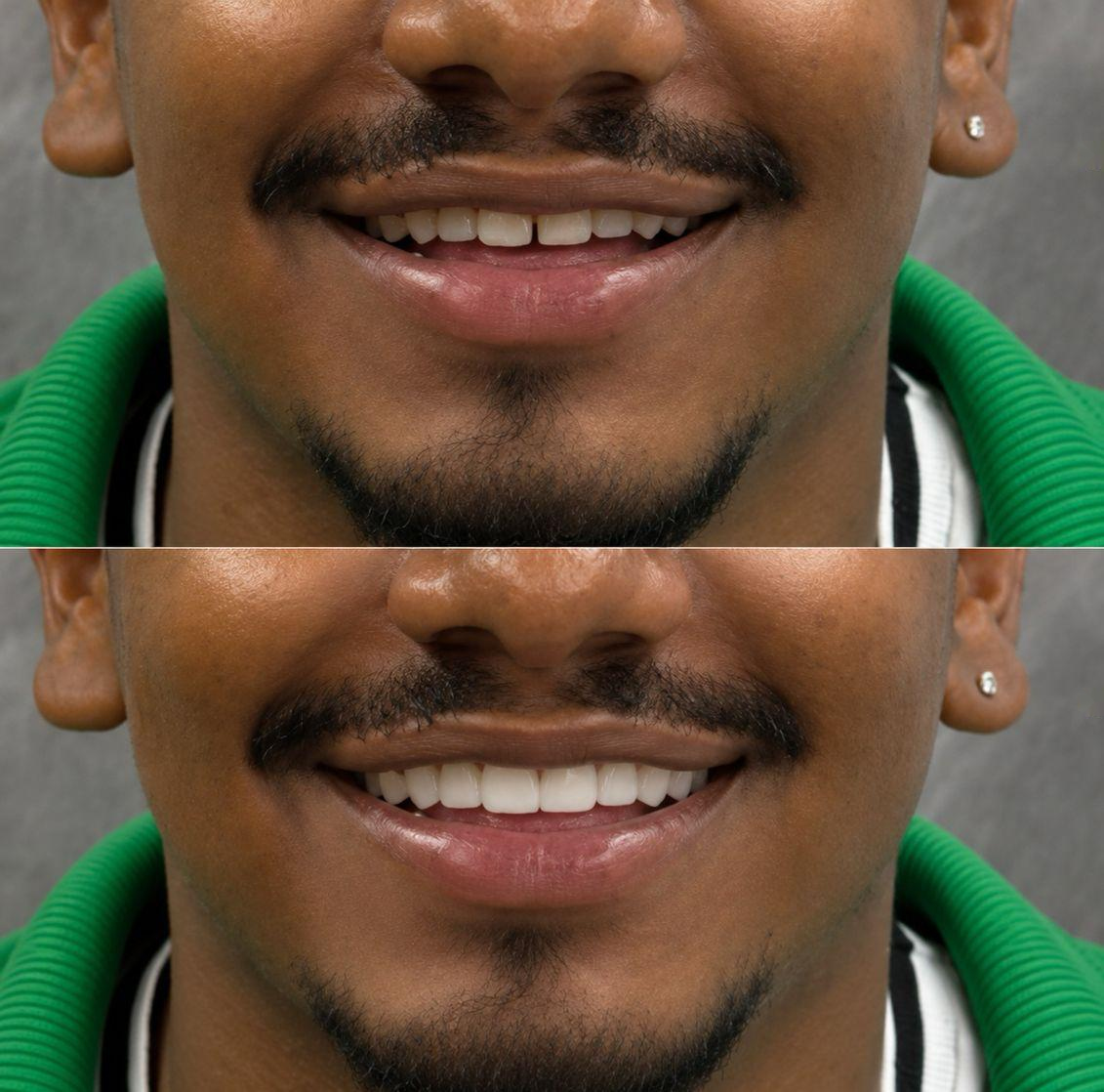 Antes y después de un caso real de diseño de sonrisa en Soi Smile