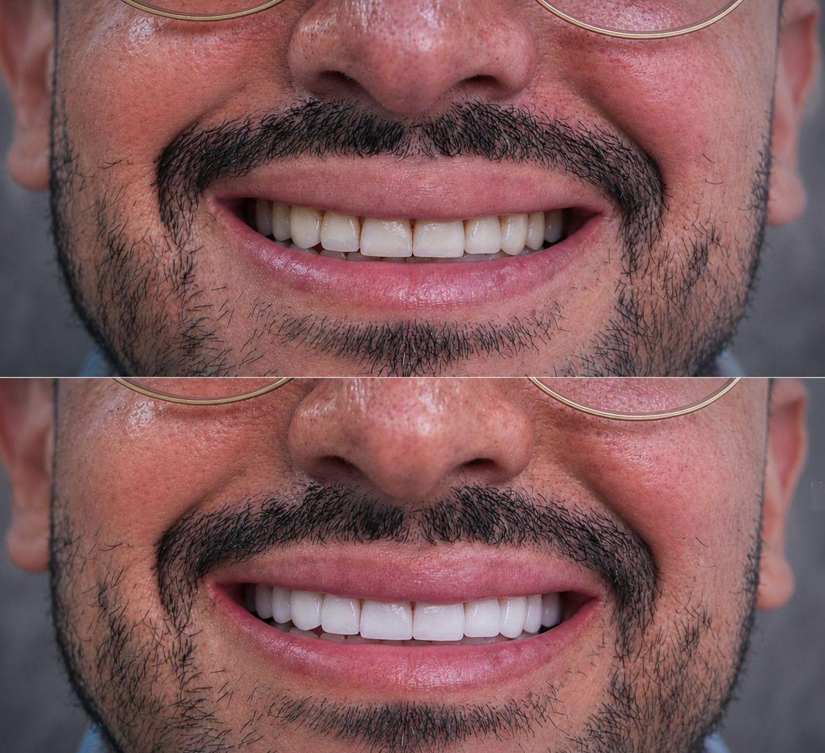 Antes y después de un caso real de diseño de sonrisa en Soi Smile