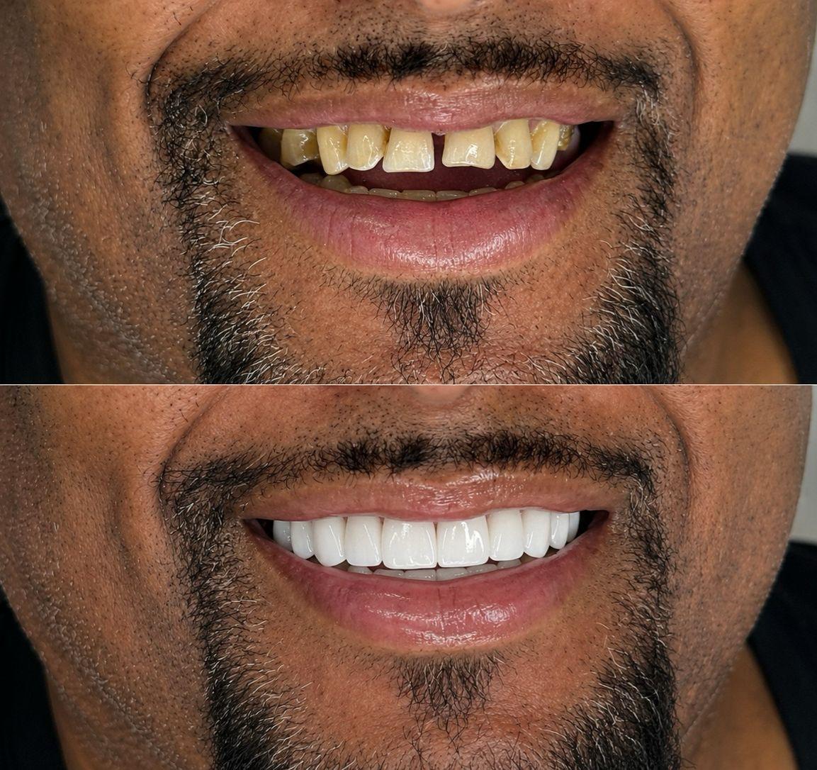 Antes y después de un caso real de diseño de sonrisa en Soi Smile